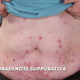 Image for article titled Dr. Pimple Popper Treats Someone With a Tennis Ball-Sized Lump in His Neck